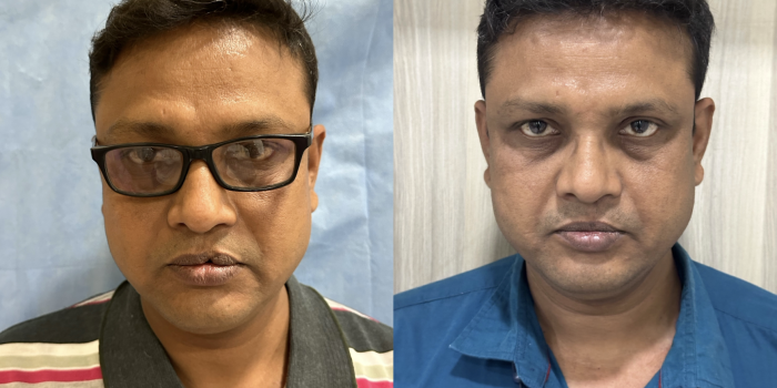 Before and After Surgery